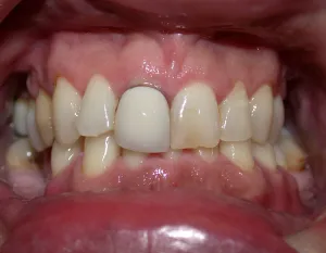 Picture of teeth prior to restoration