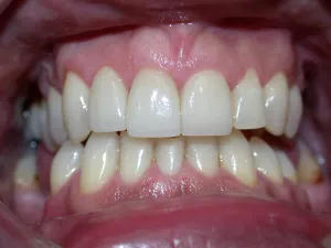 Picture of teeth after restoration