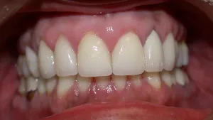 Picture of teeth after restoration