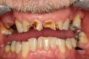 Picture of teeth prior to restoration